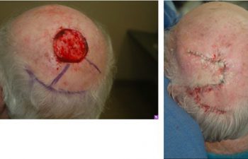 Scalp Reconstruction - Scalp Reconstruction performed for large post-Mohs defects using a multi-flap reconstruction technique.