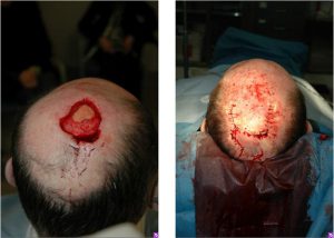 Before & After Scalp Reconstruction - Scalp Reconstruction performed for large post-Mohs defects using a multi-flap reconstruction technique.