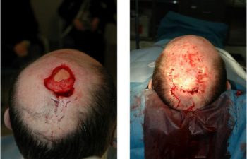 Scalp Reconstruction - Scalp Reconstruction performed for large post-Mohs defects using a multi-flap reconstruction technique.