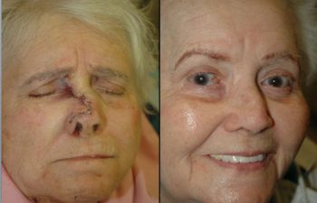 Before & After Imperceptible scar - Meticulous soft tissue technique results in an imperceptible scar.