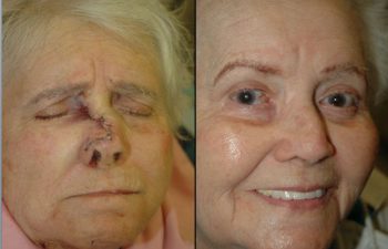 Imperceptible scar - Meticulous soft tissue technique results in an imperceptible scar.