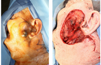 Wide local excision for melanoma with a secondary large lateral cheek defect - 82 year old male undergoing wide local excision for melanoma with a secondary large lateral cheek defect requiring a cervicofacial myocutaneous bilobed flap reconstruction.