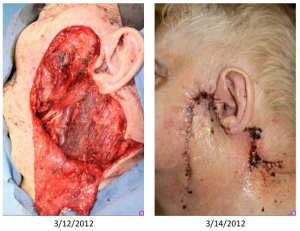 Before & After Wide local excision for melanoma with a secondary large lateral cheek defect - Wide local excision for melanoma with a secondary large lateral cheek defect - 82 year old male undergoing wide local excision for melanoma with a secondary large lateral cheek defect requiring a cervicofacial myocutaneous bilobed flap reconstruction.