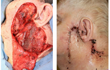Wide local excision for melanoma with a secondary large lateral cheek defect - 82 year old male undergoing wide local excision for melanoma with a secondary large lateral cheek defect requiring a cervicofacial myocutaneous bilobed flap reconstruction.