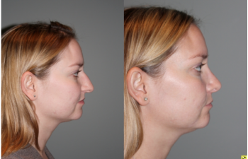 Cosmetic Rhinoplasty - Cosmetic Rhinoplasty performed on 29yo female for bridge/hump reduction and tip refinement. Right side view.