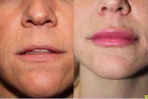 Before & After Lip augmentation with Juvederm - Lip augmentation with Juvederm