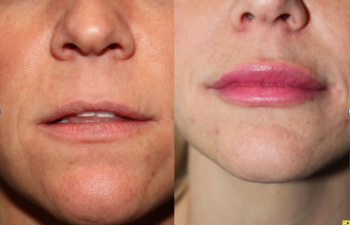 Lip augmentation with Juvederm - before and after.