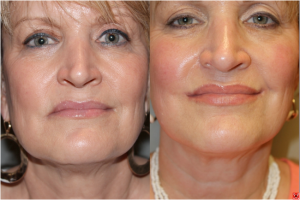 Before & After Corner Mouth Lip Lift - 55 year old female under went a corner of mouth lip lift to correct the drooping that occurs with age and create a youthful, attractive, upturn at the corners of the mouth.