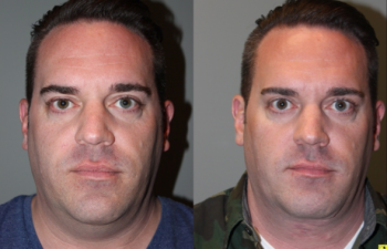Before & After Male Direct Neck Lift - Male Direct Neck Lift - 39 year old male one year follow up after Grecian Urn direct neck lift.
