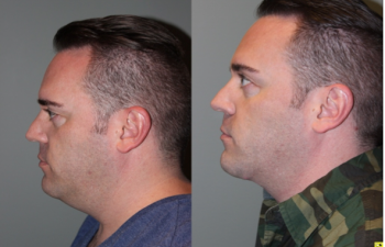 Before & After Male Direct Neck Lift - 39 year old male one year follow up after Grecian Urn direct neck lift.
