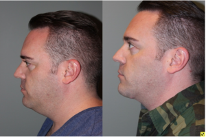 Before & After Male Direct Neck Lift - 39 year old male one year follow up after Grecian Urn direct neck lift.