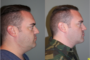 Before & After Male Direct Neck Lift - Male Direct Neck Lift - 39 year old male one year follow up after Grecian Urn direct neck lift.