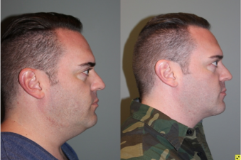 Male Direct Neck Lift - 39 year old male one year follow up after Grecian Urn direct neck lift.