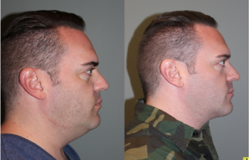 Male Direct Neck Lift - 39 year old male one year follow up after Grecian Urn direct neck lift.