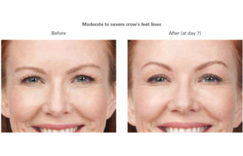Moderate to severe smile lines -