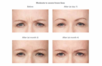 Moderate to severe frown lines -