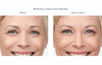 Moderate to severe crow’s feet lines - before and after.