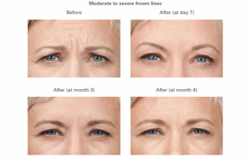 Moderate to severe frown lines - before and after.