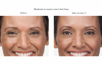 Moderate to severe smile lines -