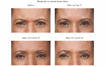 Moderate to severe frown lines -