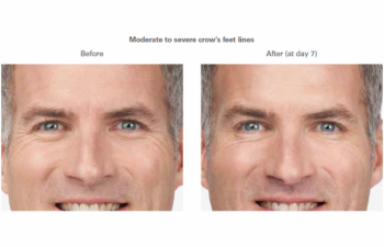 Moderate to severe smile lines -