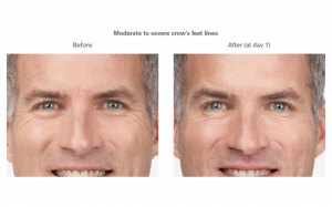 Moderate to severe smile lines - before and after.