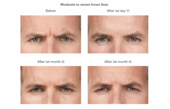 Moderate to severe frown lines -