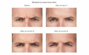 Moderate to severe frown lines - before and after.