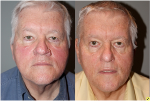 Before & After Rhinophyma - 71 year old male with Rhinophyma 6 months following electrocautery loop excision.