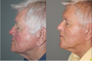 Before & After Rhinophyma - 71 year old male with Rhinophyma 6 months following electrocautery loop excision.