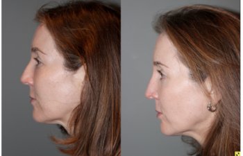 Blepoharoplasty/Rhinoplasty -