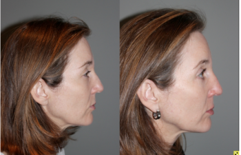 Blepoharoplasty/Rhinoplasty -