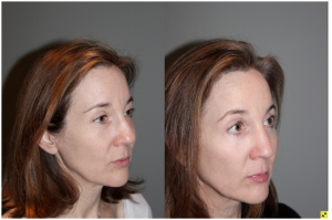 Blepoharoplasty/Rhinoplasty - 52 yo female s/p upper blepoharoplasty, lower blepharoplasty with fat transposition, and a rhinoplasty to refine tip and narrow bridge. Patient requested subtle results and not to alter height of the bridge of her nose.