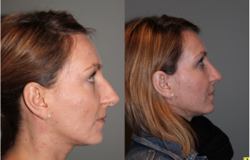 Rhinoplasty - 39 year old female 3 months following her rhinoplasty.