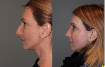 Rhinoplasty - 39 year old female 3 months following her rhinoplasty.