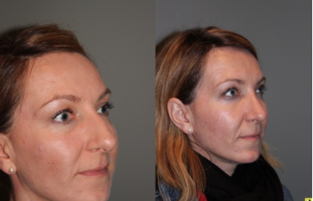 Rhinoplasty - 39 year old female 3 months following her rhinoplasty.