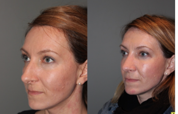 Rhinoplasty - 39 year old female 3 months following her rhinoplasty.