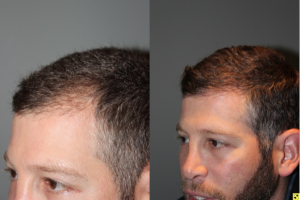 36 yo male 6 months after neograft hair transplant procedure with 1500 grafts- View 1 -
