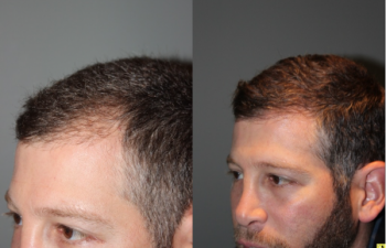 36 yo male 6 months after neograft hair transplant procedure with 1500 grafts- View 1 -