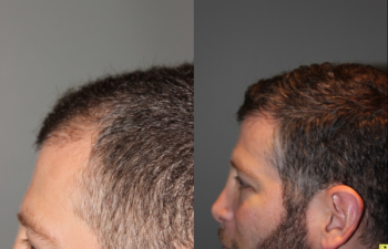 36 yo male 6 months after neograft hair transplant procedure with 1500 grafts- View 2 -
