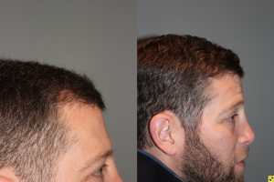 36 yo male 6 months after neograft hair transplant procedure with 1500 grafts- View 3 -