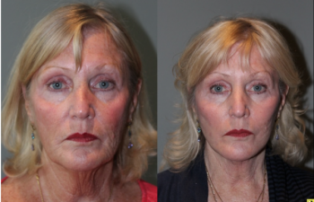 S-lift Mini Deep Plane Facelift - 71 Year old female 5 months post op from and S-lift Mini Deep Plane Facelift