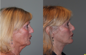 S-lift Mini Deep Plane Facelift - 71 Year old female 5 months post op from and S-lift Mini Deep Plane Facelift