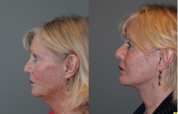 S-lift Mini Deep Plane Facelift - 71 Year old female 5 months post op from and S-lift Mini Deep Plane Facelift