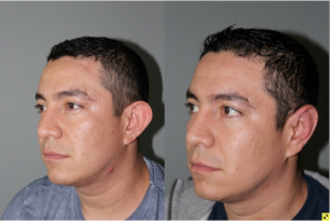 30 Year old male two weeks after invisible scar otoplasty -