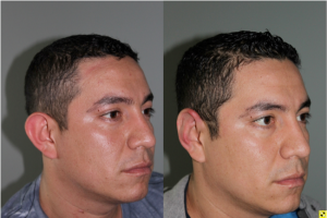 30 Year old male two weeks after invisible scar otoplasty -