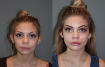 Juvederm Lip Injections - 19 year old female immediately following bruise free Juvederm lip injections.