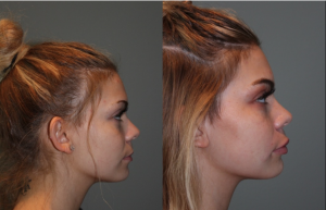 Juvederm Lip Injections - 19 year old female immediately following bruise free Juvederm lip injections.