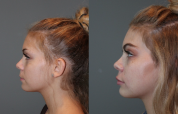Juvederm Lip Injections - 19 year old female immediately following bruise free Juvederm lip injections.