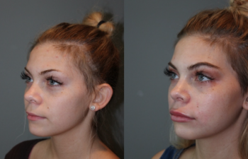 Juvederm Lip Injections - 19 year old female immediately following bruise free Juvederm lip injections.